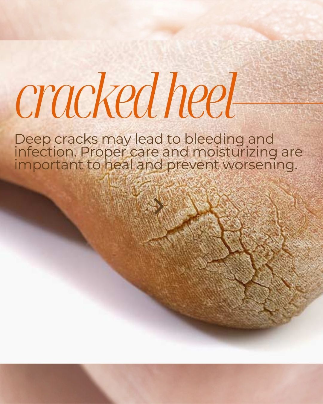 CRACKED, DRY HEELS