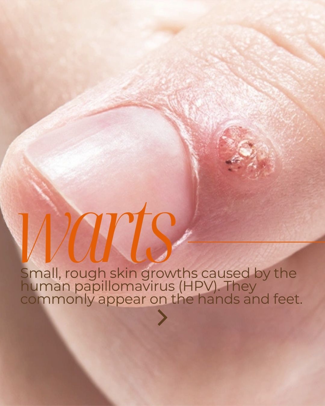 WART TREATMENT