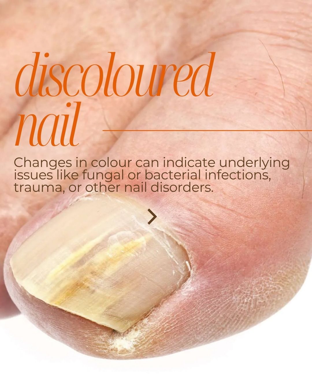 NAIL RESTORATION