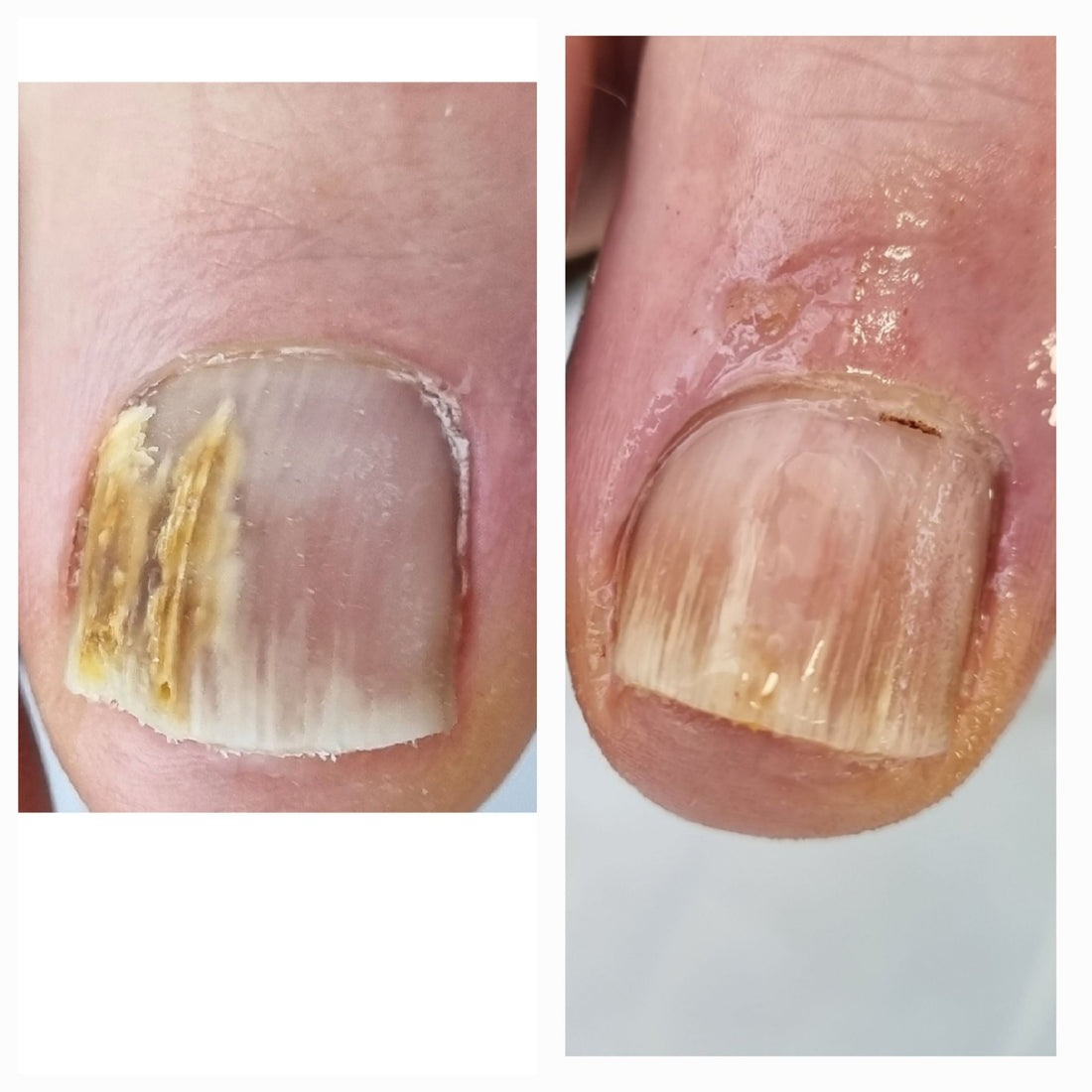 onychomycosis nail fungal infection